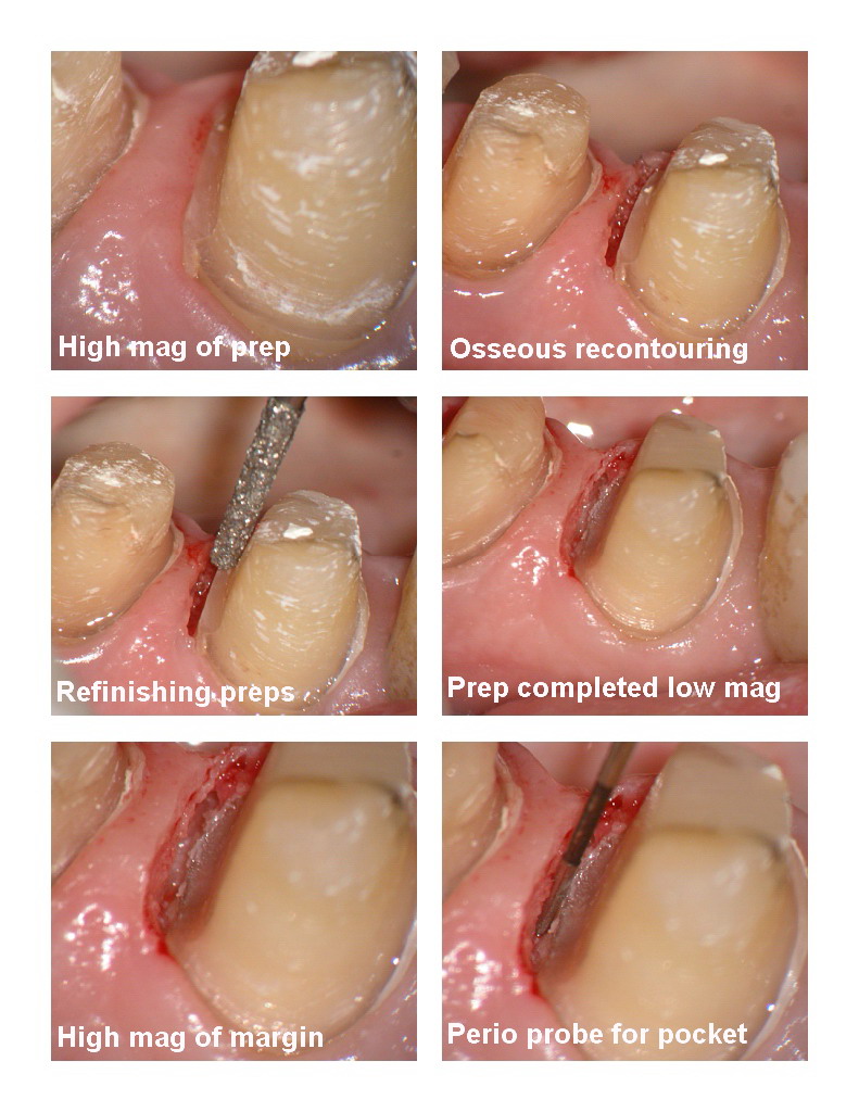 Premolar osseous pg 2.jpg